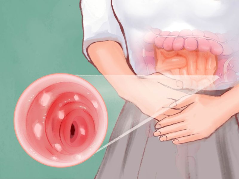 che-do-an-kieng-cho-nguoi-viem-loet-dai-trang-8