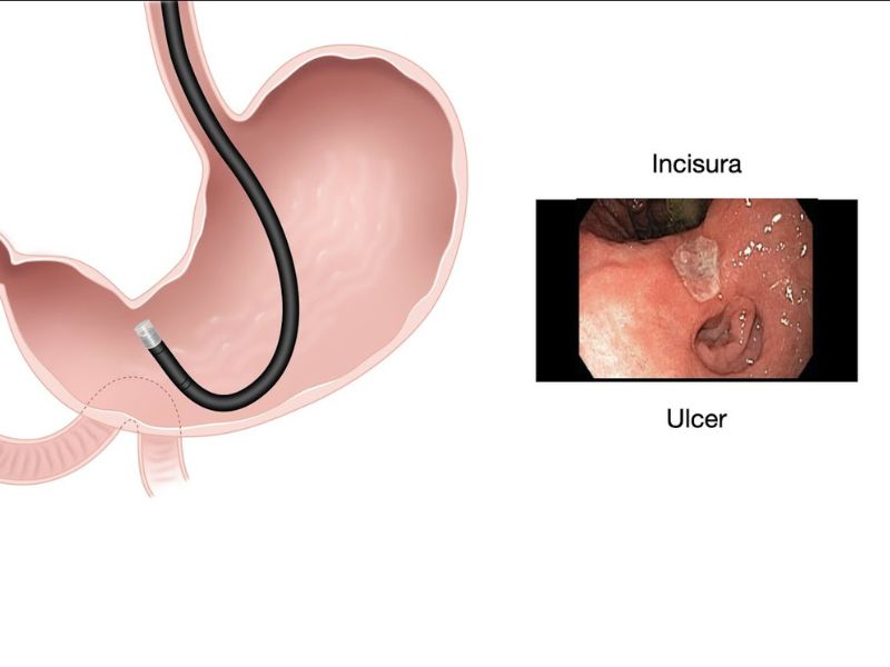 chan-doan-ung-thu-da-day-5