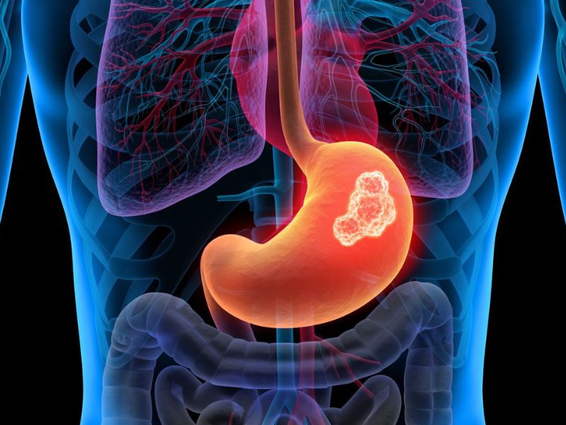 ung-thu-da-day-song-duoc-bao-lau-2