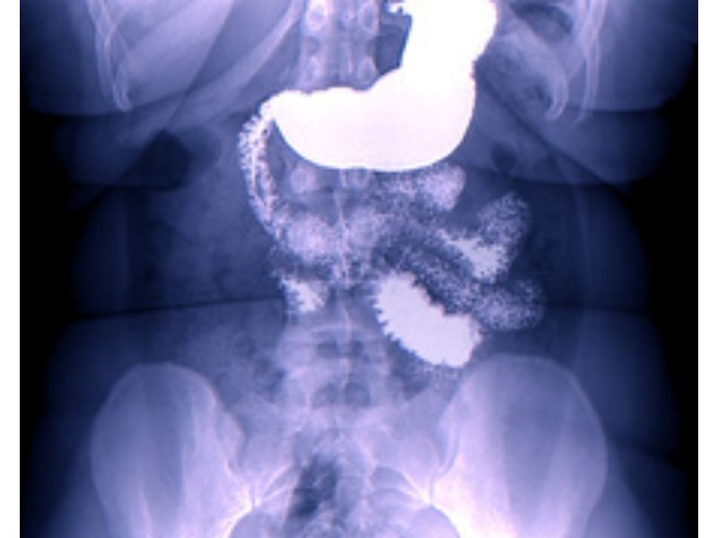 chan-doan-ung-thu-da-day-6