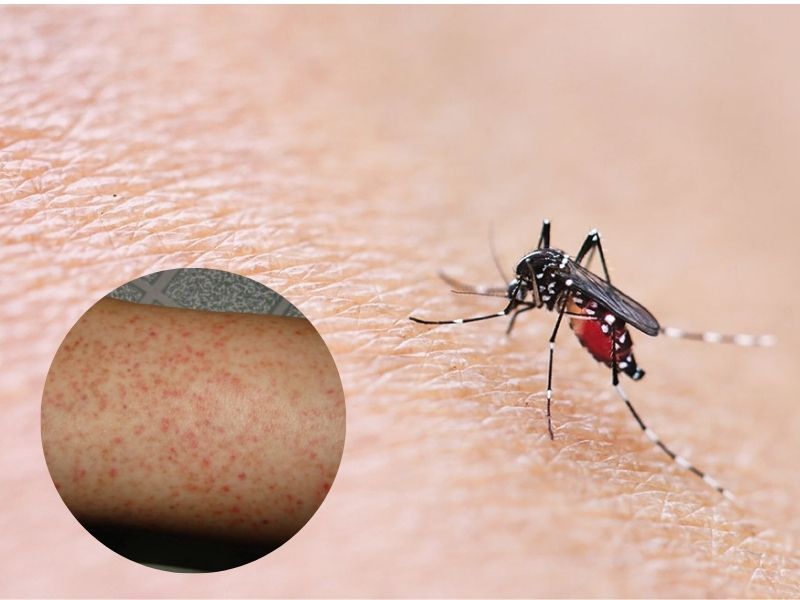 xet-nghiem-sot-xuat-huyet-2