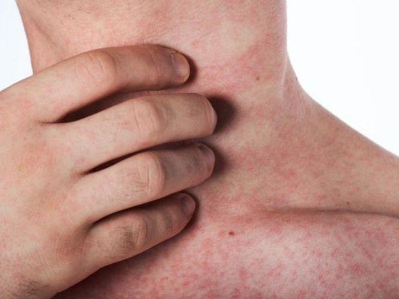 cac-giai-doan-sot-xuat-huyet-3