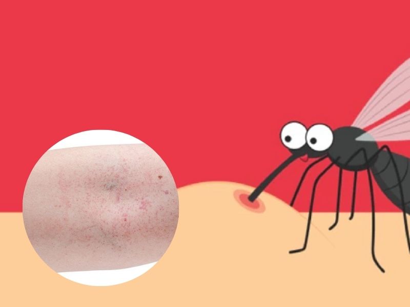 cac-giai-doan-sot-xuat-huyet-1.