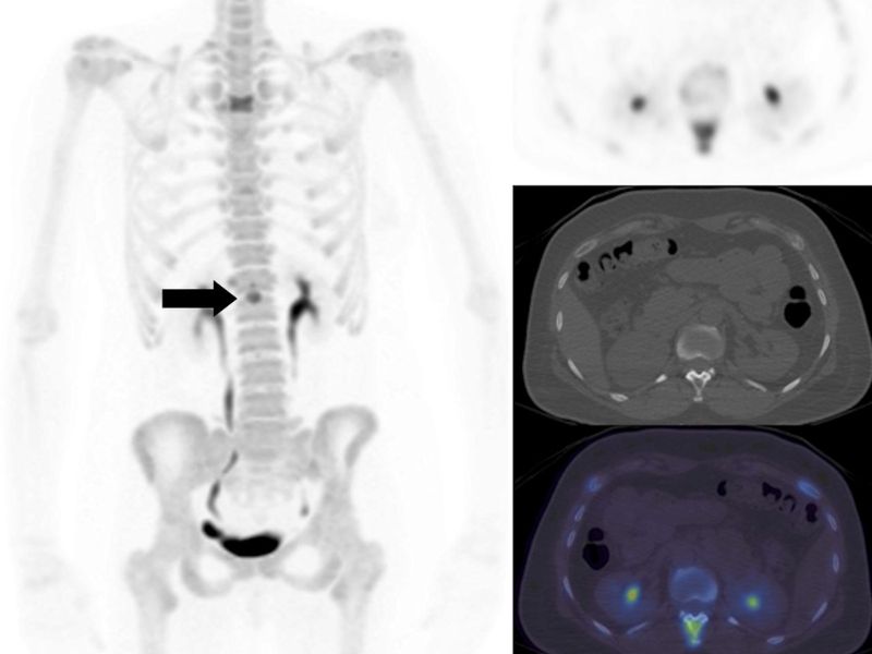 ung-thu-vu-di-can-xuong-3