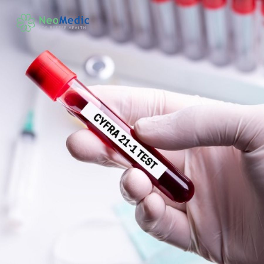 Định lượng Cyfra 21-1: Khi nào cần làm xét nghiệm?